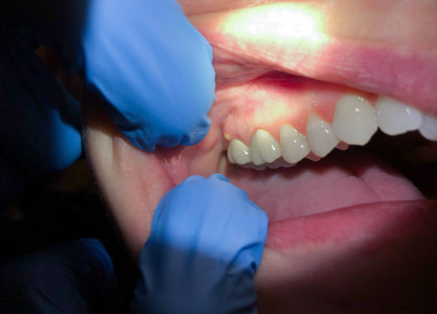 Best Emergency Tooth Extraction in Corydon, IA